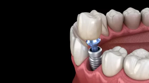 dental-implant-model-1024x512